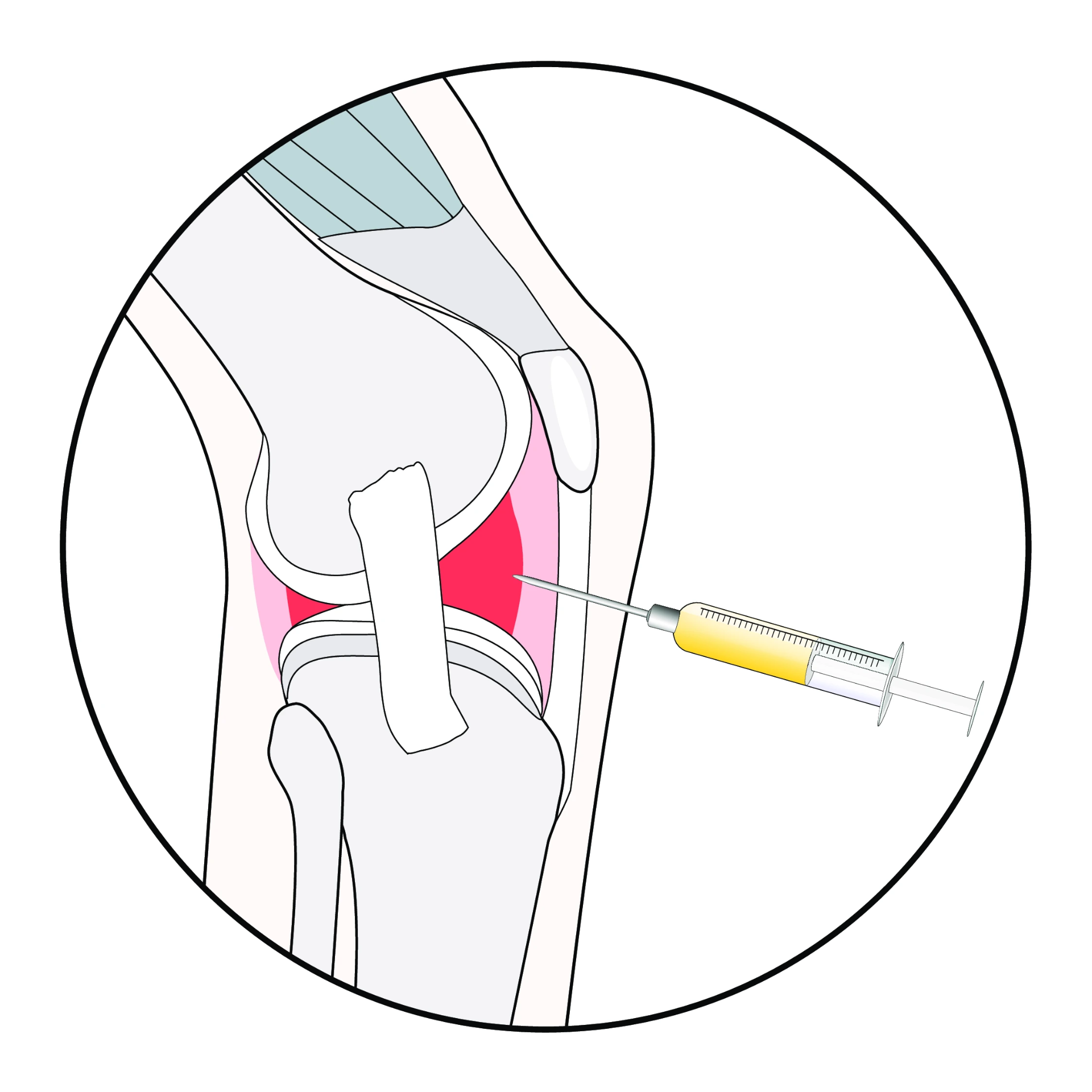 Medical diagram of the knee joint with a syringe performing an intra-articular injection