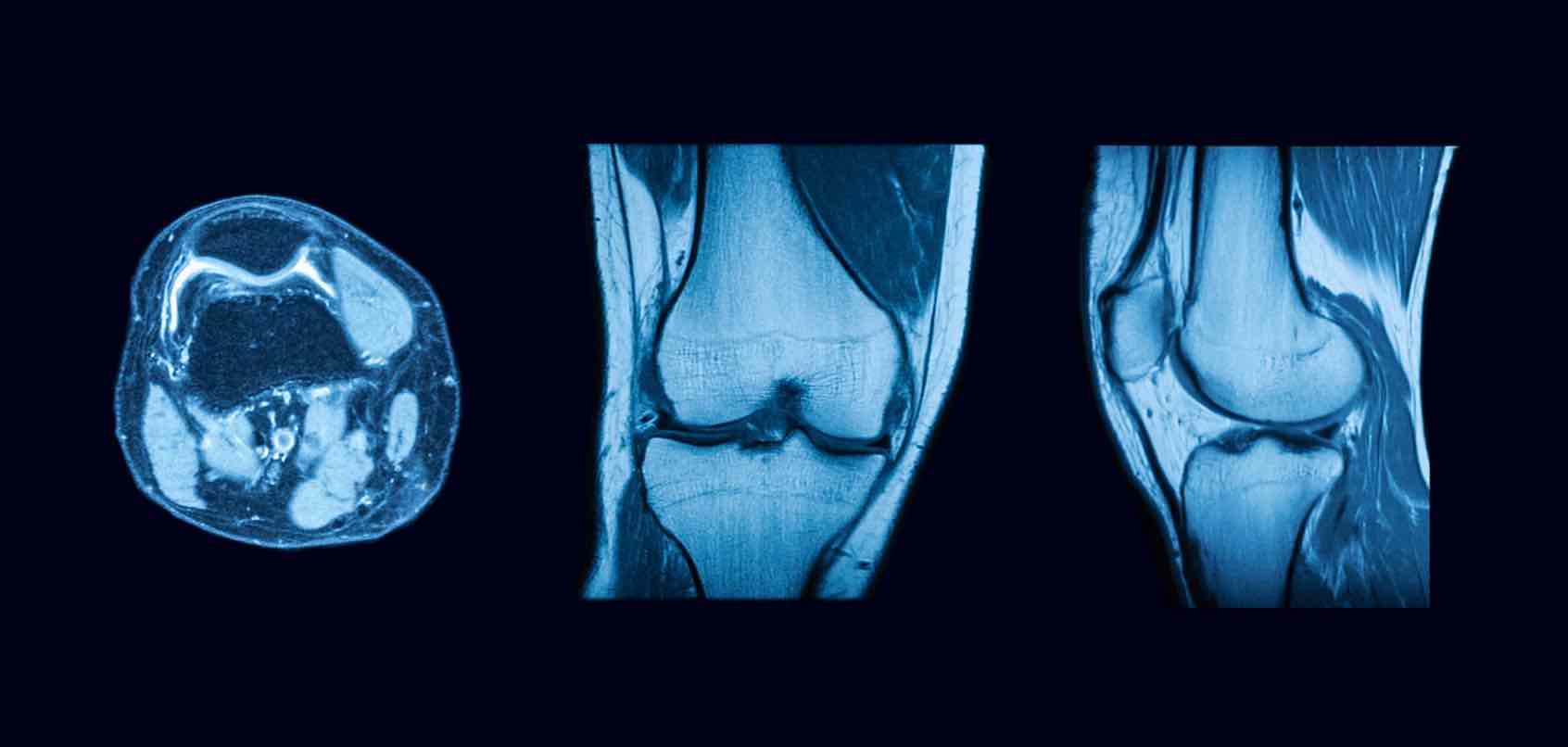 Composite of axial, sagittal and coronal knee MRI slices in a single image.