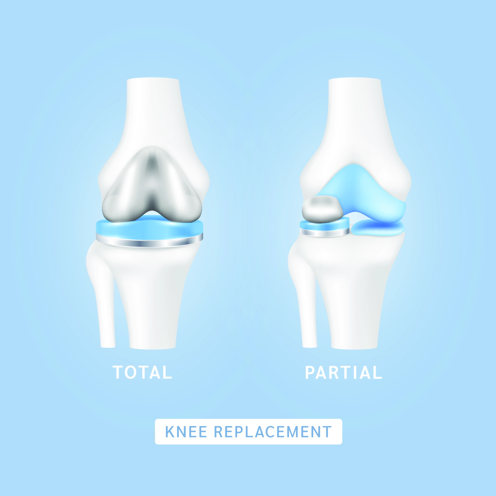 Side-by-side knee implant models showing unicompartmental (UKR) and total knee replacement (TKR)