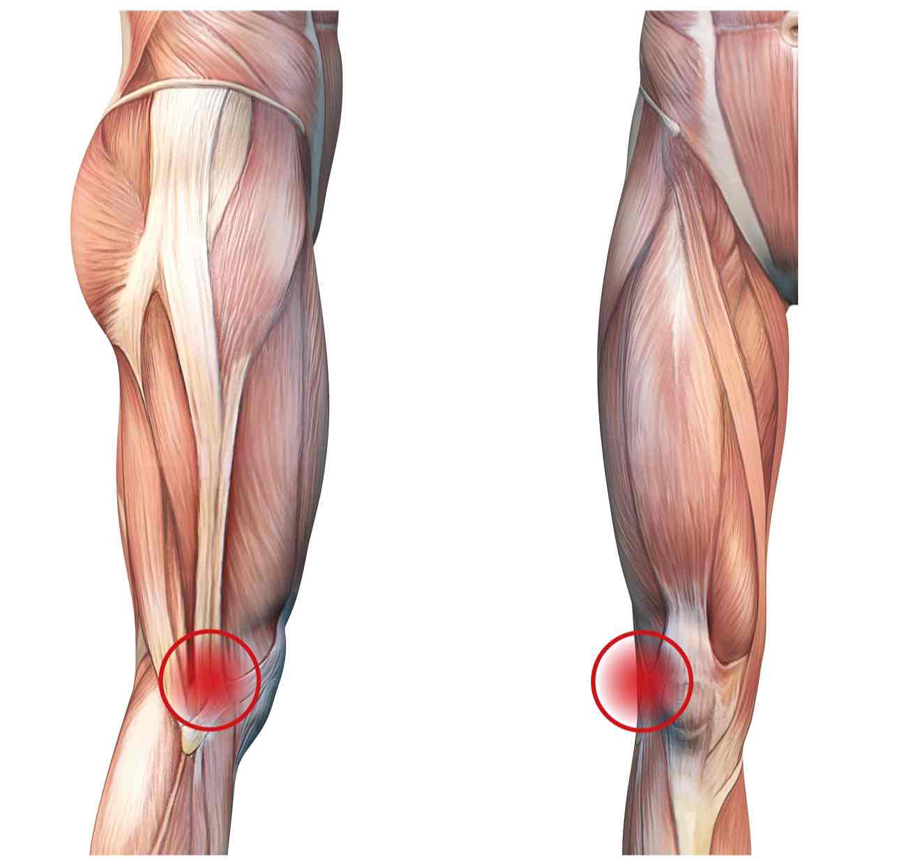 Lateral extra-articular tenodesis (LET) in Reading — Mr Sam Nahas Diagram illustrating the iliotibial band and the area of surgery.