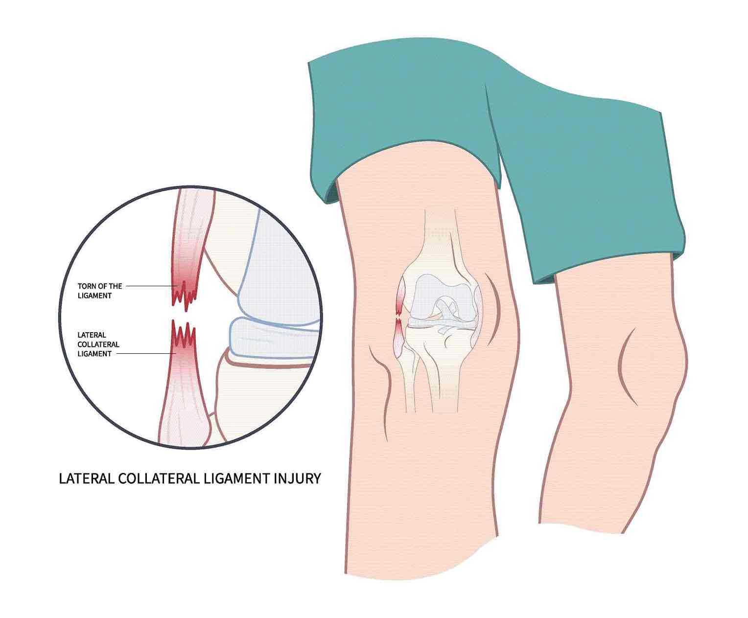 Anatomical diagram highlighting the lateral collateral ligament (LCL) within the posterolateral corner of the knee.