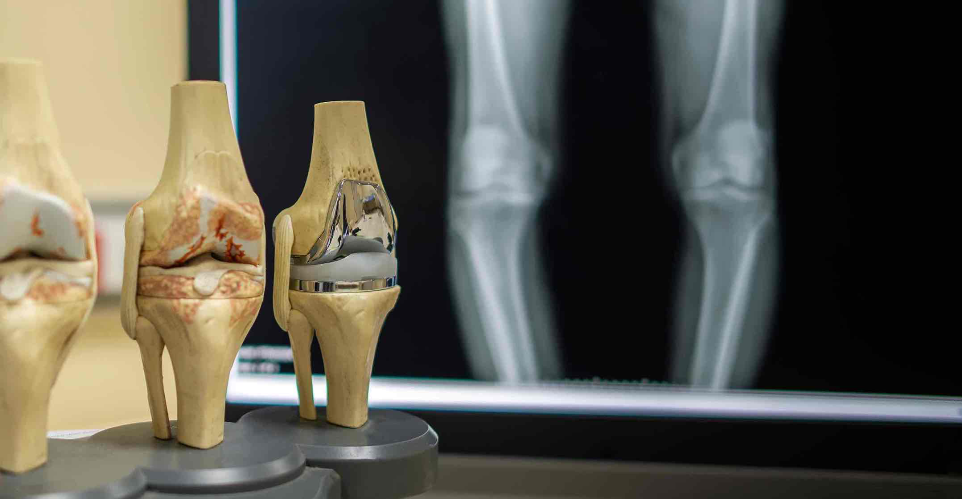 Close-up of a patient's knee during walking assessment, representing total knee replacement (TKR) care